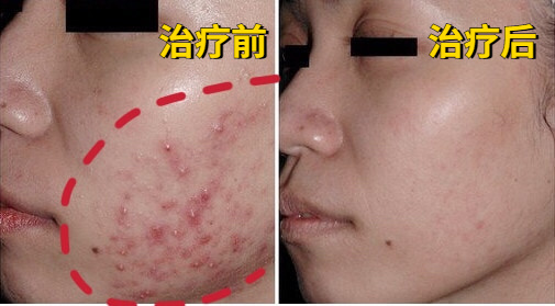 痘肌必看果酸换肤详细指南,果酸换肤对治疗痘痘作用大吗