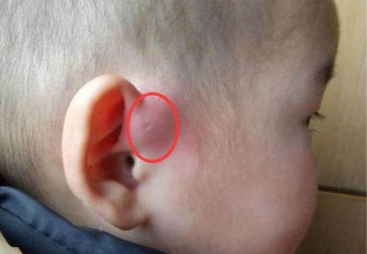 为什么婴儿耳朵后边都有一个疙瘩,耳朵有个小孔是怎么回事流水很臭