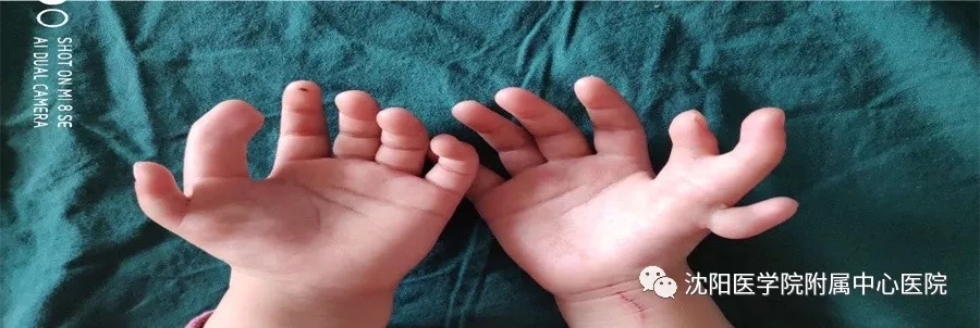 完美矫治畸形双手——沈医中心医院为先天有14根手指的小女孩成功再造健康双手