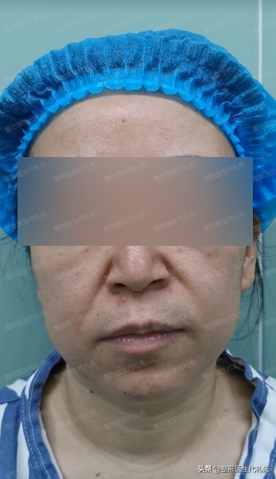 皮肤下垂松弛做什么美容好,30岁面部松弛下垂整形对比