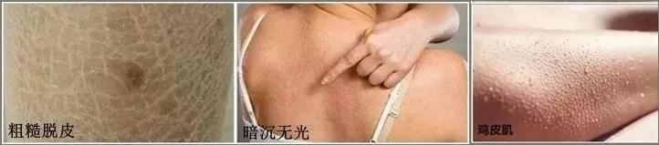 祛背部痘印的日常方法,用什么可以祛后背痘印