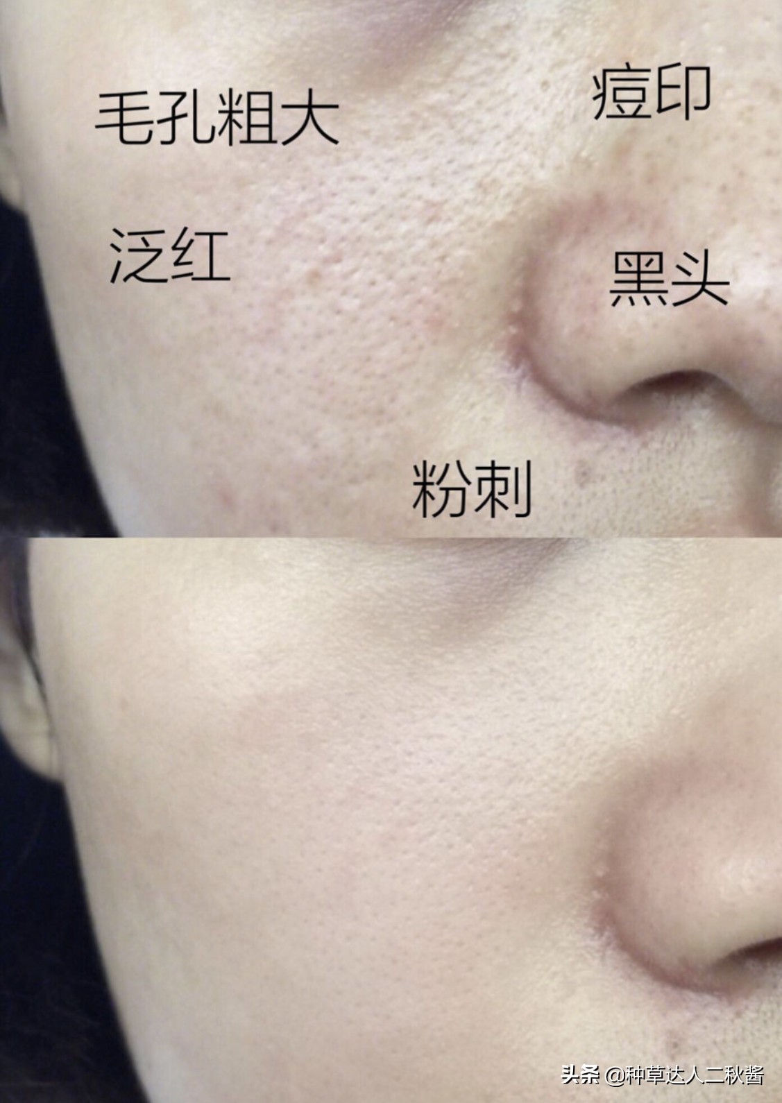 男士毛孔粗大出油黑头用什么护肤,毛孔粗大皮肤干如何正确护肤