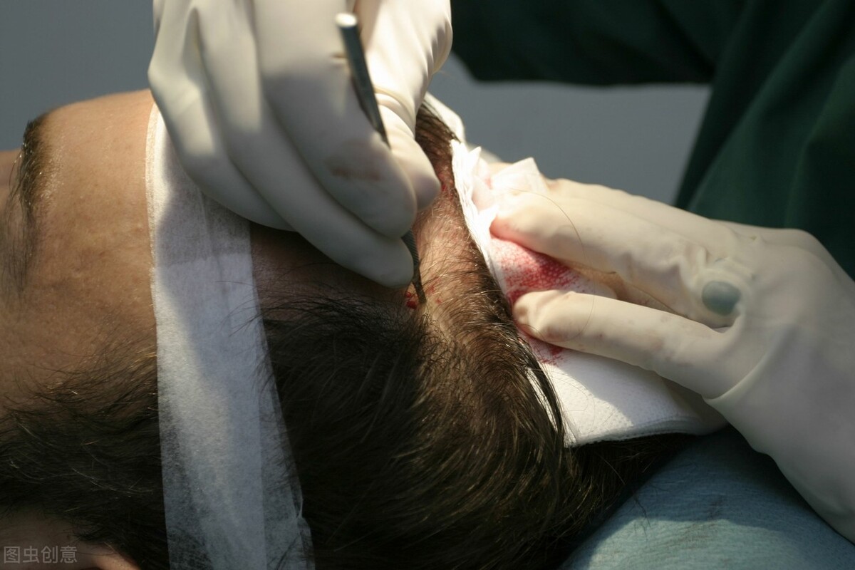 雄激素脱发植发的危害和后遗症,植发以后的后遗症和注意事项