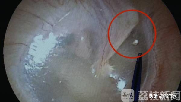 女孩耳朵总是沙沙作响，一查竟是因为“吸猫”