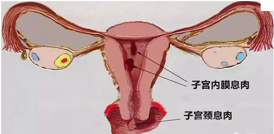 肠息肉切除好还是不切除好,肠息肉切除还是不切除好