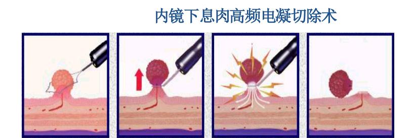 多发息肉和单发息肉哪个容易癌变,分叶息肉和带蒂息肉哪个容易癌变