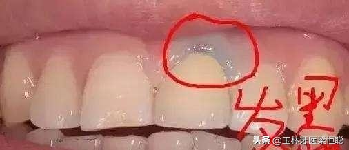 全瓷牙和烤瓷牙冠的区别,烤瓷牙和全瓷牙冠有什么区别