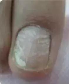 足疗店灰指甲治疗费用大概多少钱,得了灰指甲一个传染俩靠谱吗