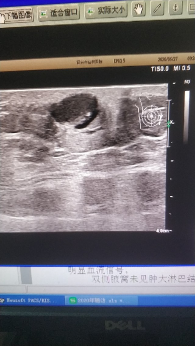 皮脂囊肿简介,皮脂囊肿和脂肪囊肿的区别