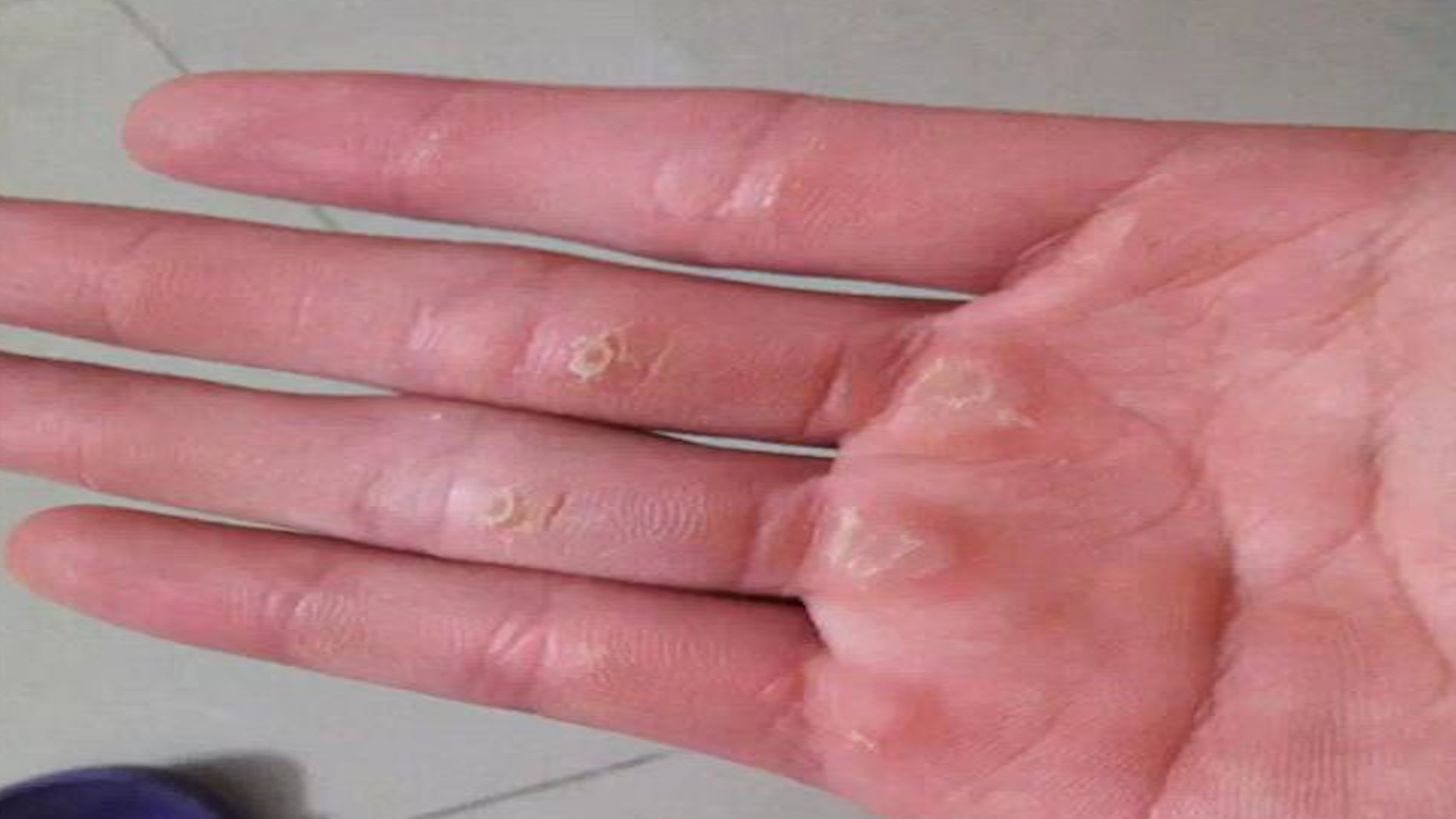 手上起老茧有什么方法除掉,手上老茧去除方法