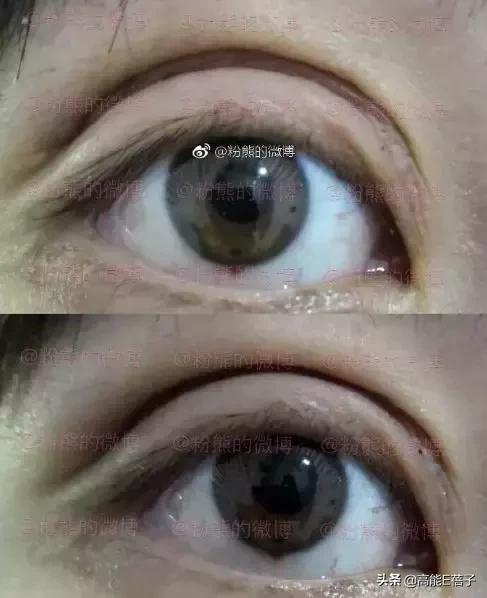 微整形需要多久,最受欢迎的5大微整形