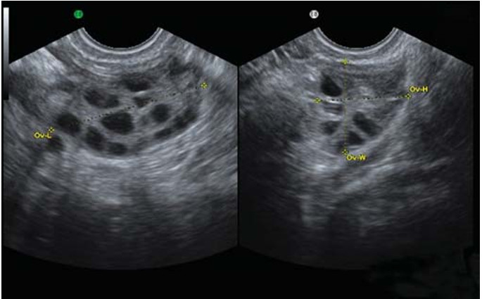 多囊卵巢综合征不孕不育能结婚吗,肥胖引起多囊卵巢不孕怎么办
