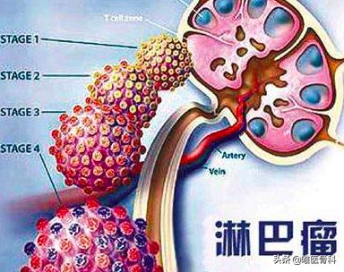 第一例新型冠状病毒遗体解剖真相,新型冠状病毒肺炎人体解剖