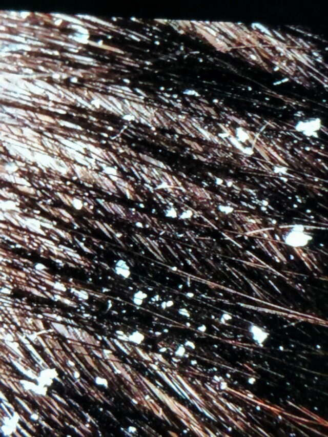 去头皮屑就这么简单，这一招我服，非常感谢鹤叔的推荐！