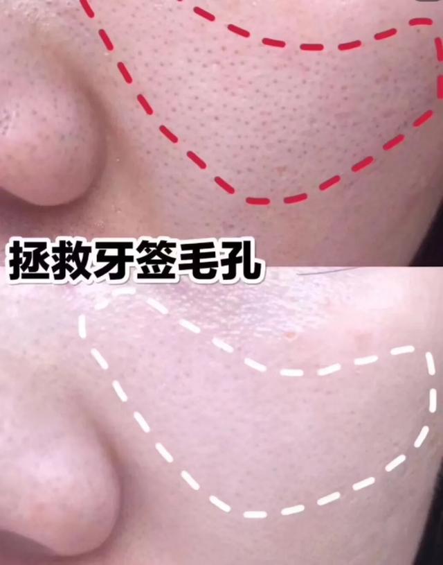 毛孔黑头堵塞严重变成一片疙瘩,敏感肌毛孔堵塞黑头怎么改善