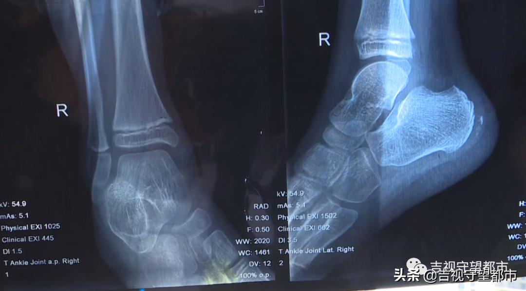 攀岩小孩摔伤怎么处理,攀岩孩子摔伤怎么处理