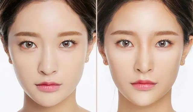 宽鼻子怎么变窄,鼻子大鼻翼宽怎么缩小