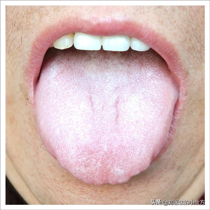 中医舌诊图解100例,中医舌诊图与舌诊口诀