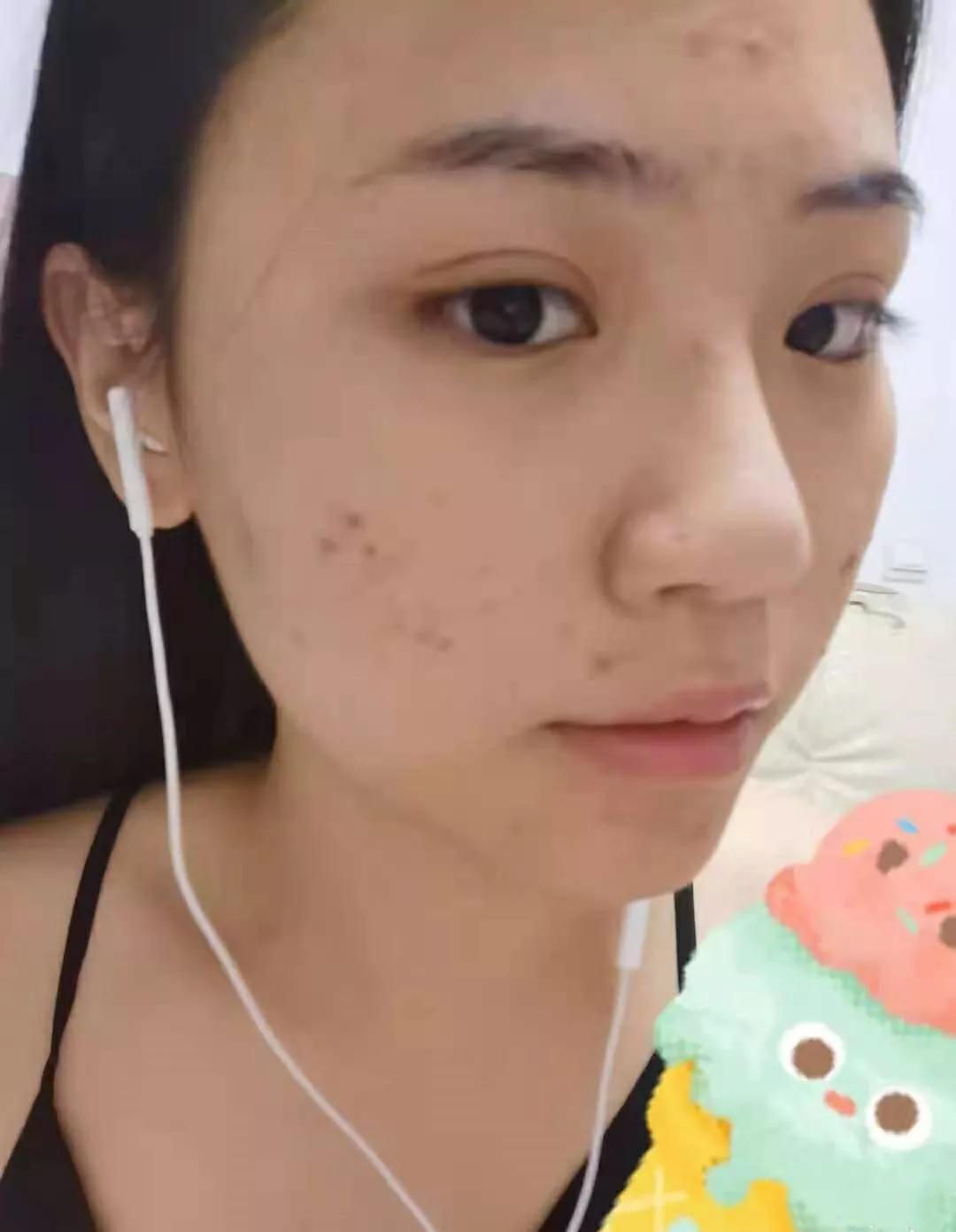 北京看痘痘好的皮肤科医院,去皮肤科看痘痘好不好