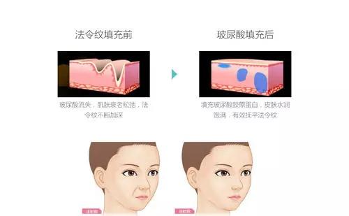 颜值丽舍：不再担心显老！1分钟解读关于法令纹的知识干货