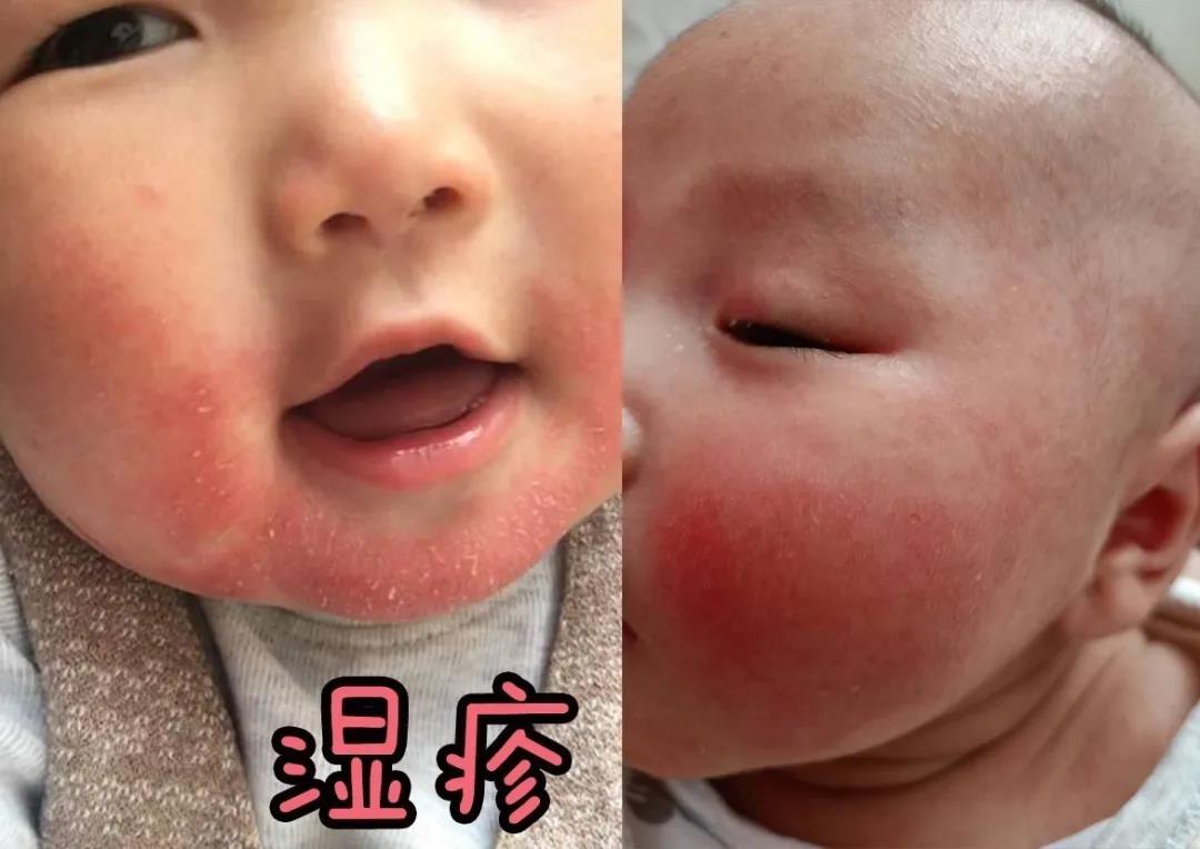 宝宝眼睛周围长湿疹要如何护理,宝宝湿疹怎么护理才能彻底治愈