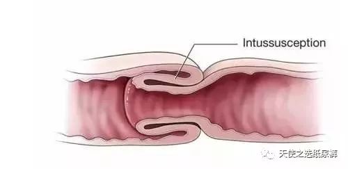 儿童肠套叠经历,小孩肠套叠经历