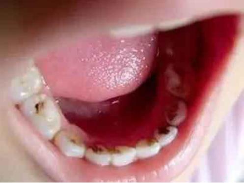 吸烟导致的口臭怎么快速解决,吸烟口干口苦口臭是什么原因