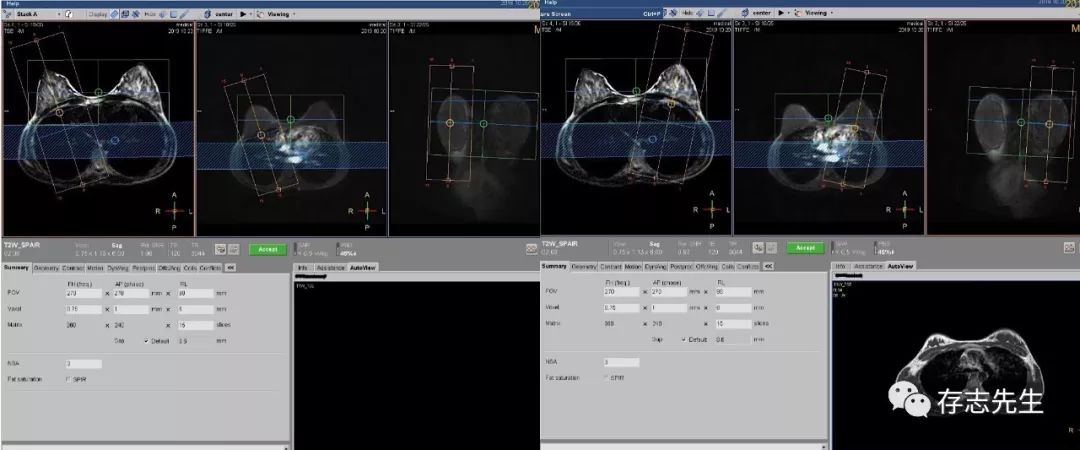 乳腺磁共振亲身经历,磁共振乳腺动态增强扫描全过程