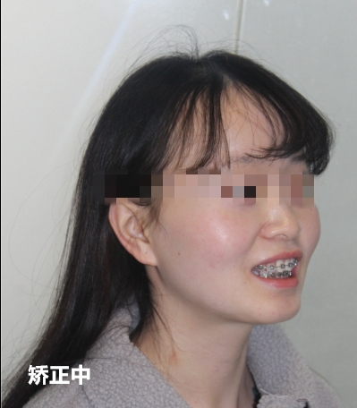 南京牙齿矫正内倾,南京牙齿矫正比较好的医院有哪些