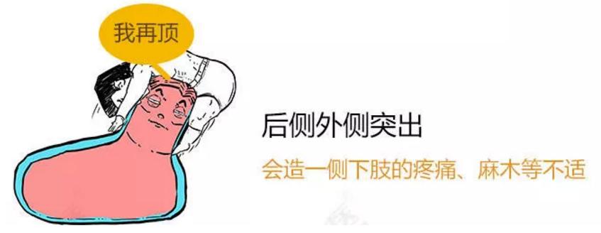 此文章让你彻底明白什么是：腰间盘突出