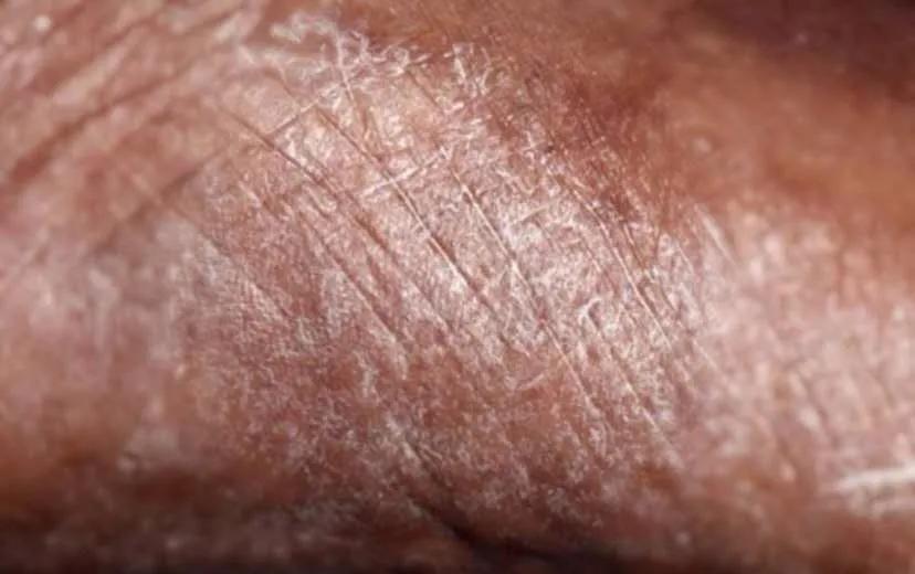 2个实用方法治疗脚气不复发,有没有治愈脚气的好方法