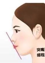 龅牙和嘴突的区别,龅牙嘴突适合什么发型