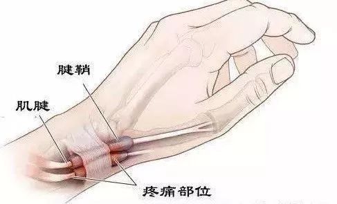 什么是封闭疗法,运动员打封闭针对身体的危害