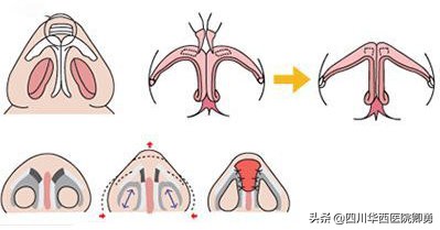 鼻中隔软骨隆鼻有什么优点,鼻中隔软骨隆鼻手术永久的吗
