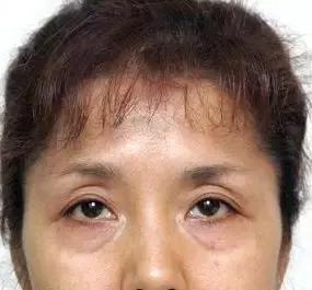 有眼袋太显老祛眼袋这里有妙招,有眼袋显老十岁一招教你消除