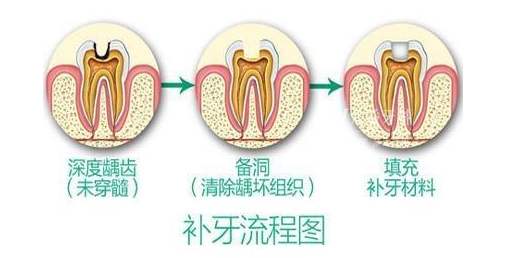 为何补牙反而要将牙洞磨大，补了之后要注意什么？听听牙医的意见