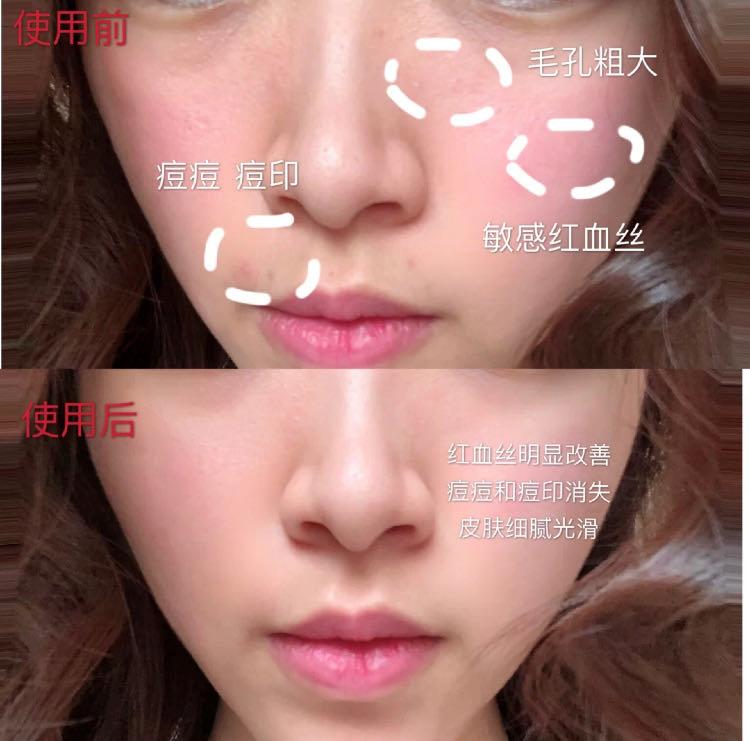 打水光针和打除皱针哪种好,打水光针和除皱针哪个好