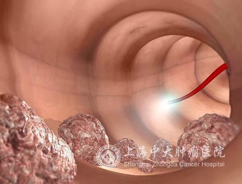 乳腺结节癌前病变会发展成癌症吗,查出癌