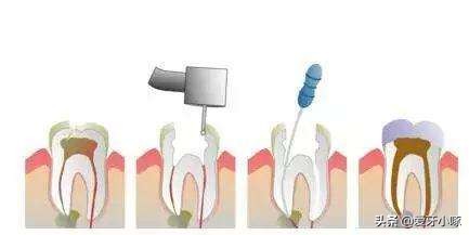 小洞不补大洞受苦早发现早治疗,为什么说牙齿小洞不补大洞吃苦