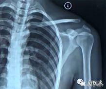 治疗肩锁关节脱位，有最好的方法吗？