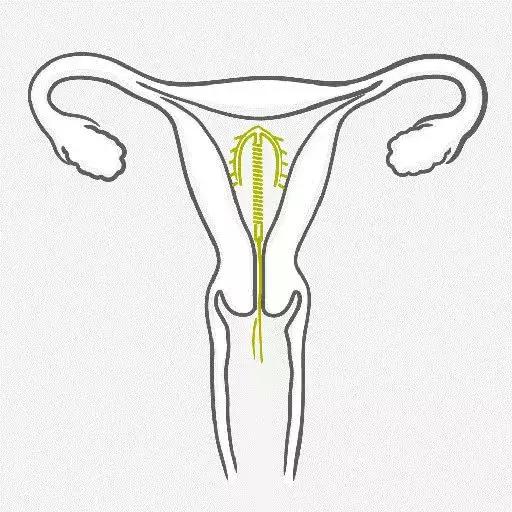 哺乳期妈妈如何避孕最有效,哺乳期妈妈纯孕激素疗法