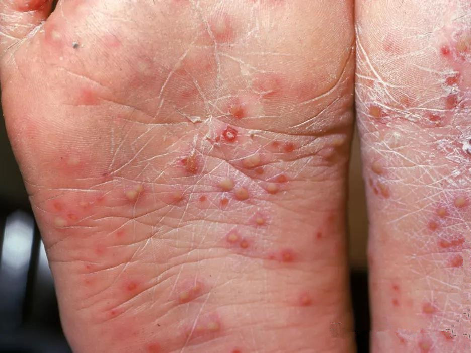 手足口病后期痊愈症状是什么,手足口病症状消失一般多少天