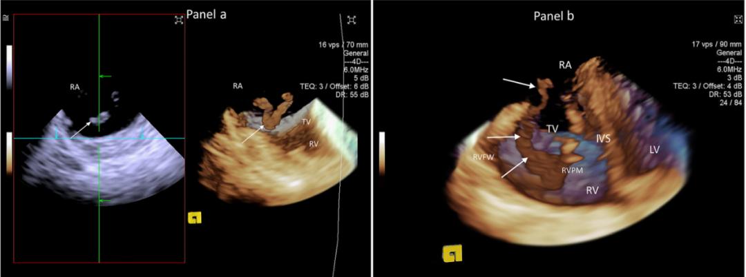 心脏电生理临床指南,心脏电生理检查可以查出哪些问题