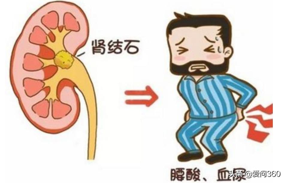 肾结石通常是什么原因导致的,肾结石是怎么形成的有什么方法