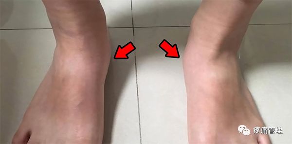 专门改善扁平足的运动,站着改善x型腿