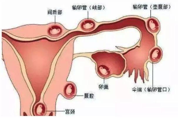 停经刚好一个月小腹痛少量出血,停经前会有不规律出血和腹痛吗