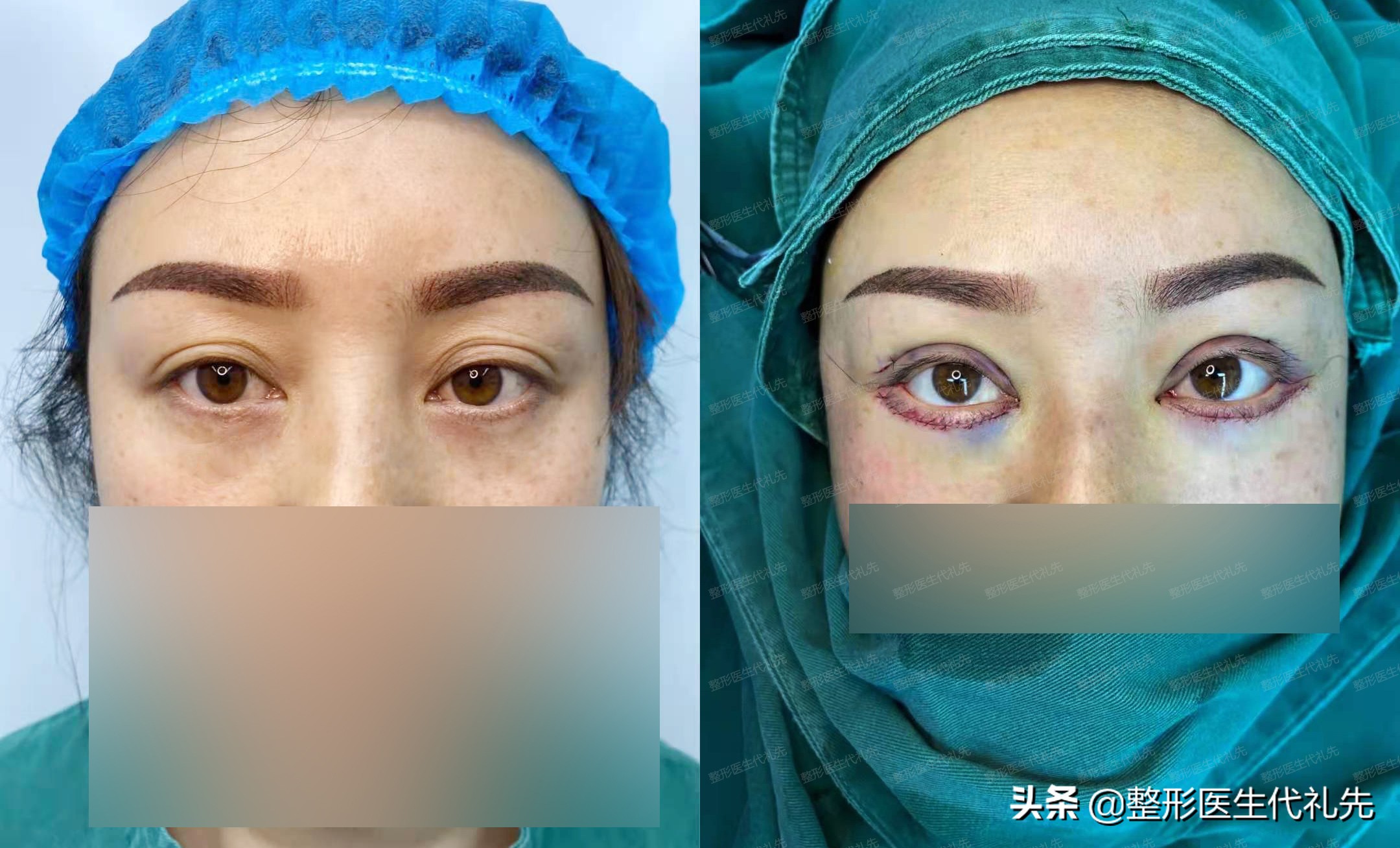 眼纹干纹是什么原因,眼部衰老导致眼纹