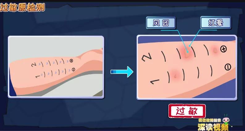 荨麻疹中医治疗多久见效,新的制剂治疗荨麻疹效果怎么样