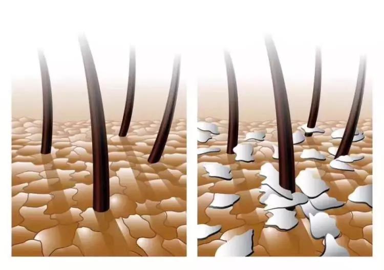 头皮屑重怎么去除头皮屑,头皮屑过多什么原因怎样去除