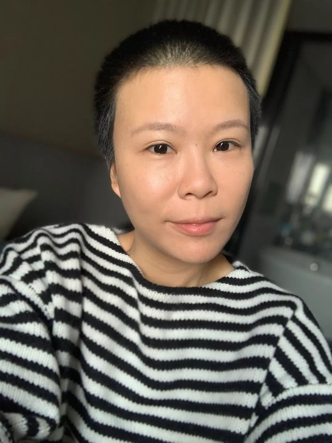 微整的真实效果,微整蜕变过程